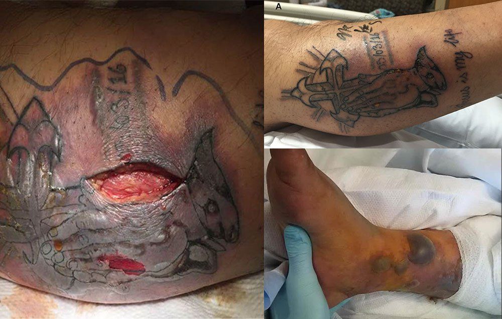 Man Dies After Contracting Bacterial Infection After Swimming With New Tattoo